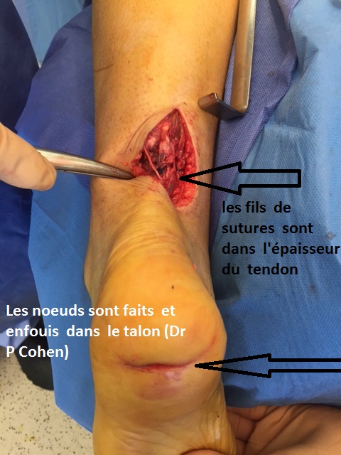 rupture du tendon d achille - tendinite du tendon d achille ...