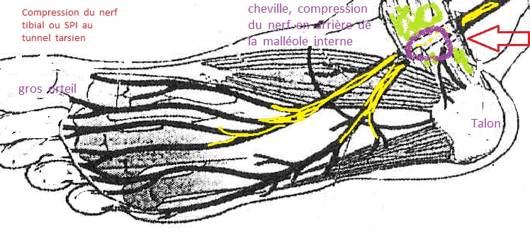 syndrome du tunnel tarsien ou compression du nerf spi ou tibial a la