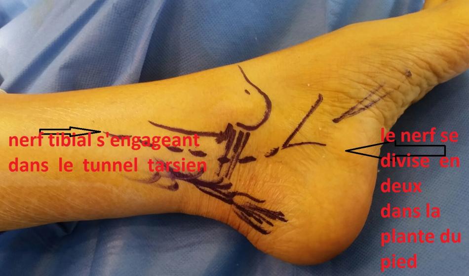 syndrome du tunnel tarsien ou compression du nerf spi ou tibial a la