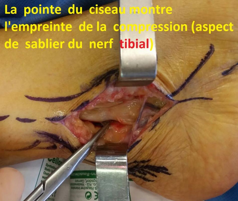 syndrome du tunnel tarsien ou compression du nerf spi ou tibial a la