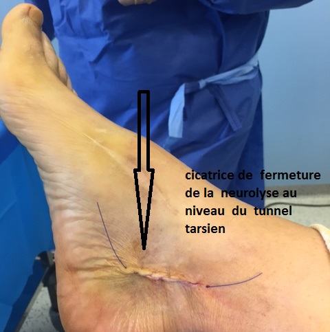 syndrome du tunnel tarsien ou compression du nerf spi ou tibial a la