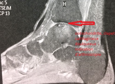 osteochondrite de cheville pathologies et operations cheville