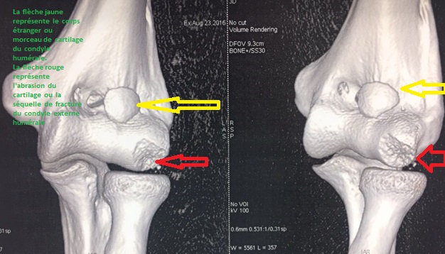 arthroscopie du coude, douleur du coude pathologies et operations ...