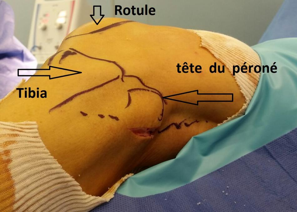 syndrome de compression du sciatique poplite externe spe ou nerf ...