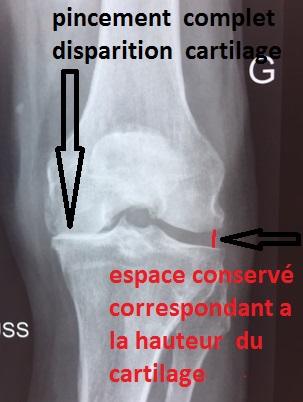 arthrose genou gonarthrose : prothese totale ou prothese partielle du