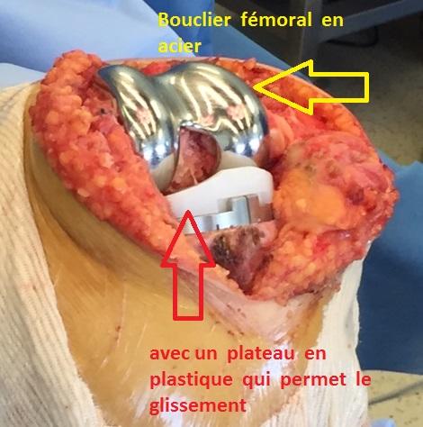 arthrose genou gonarthrose : prothese totale ou prothese partielle du