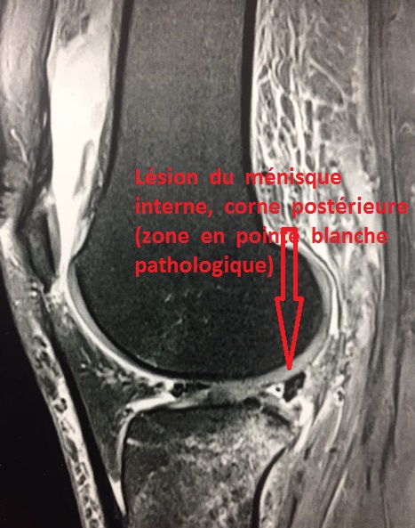 arthroscopie du genou, lesion du menisque interen et externe ...