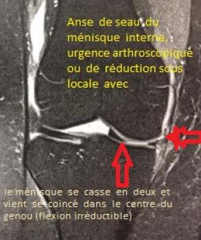 arthroscopie du genou, lesion du menisque interen et externe ...