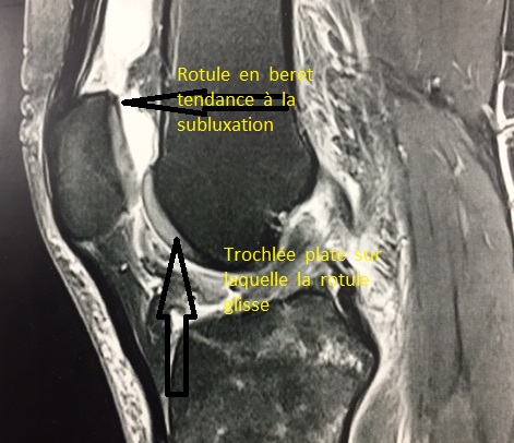 insatbilite de rotule, luxation de rotule : transposition de la ...