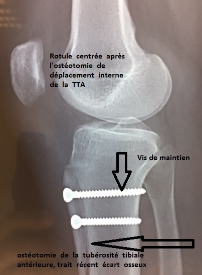 insatbilite de rotule, luxation de rotule : transposition de la ...