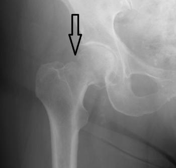 fracture du col femoral : osteosynthese et prothese de hanche ...