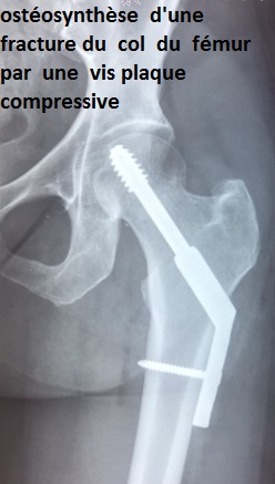 fracture du col femoral : osteosynthese et prothese de hanche ...
