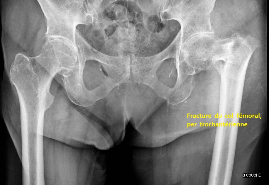 fracture du col femoral : osteosynthese et prothese de hanche ...