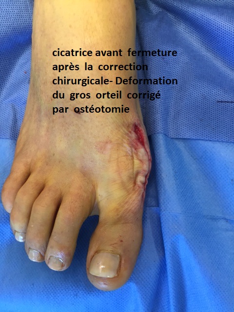 hallux valgus, orteils en griffe pathologies et operations pied