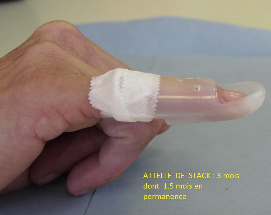 mallet finger et jersey finger pathologies et operations doigts