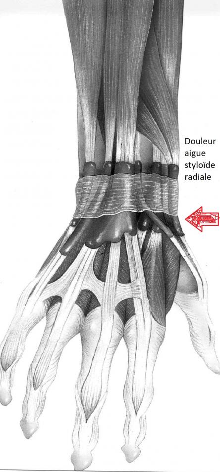 Tendinite du Pouce ou Ténosynovite de De Quervain - Groupe Clinique Drouot