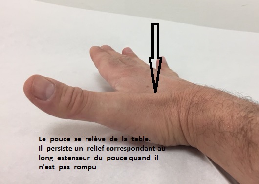 rupture du long extenseur du pouce extensor pollicis longus ...