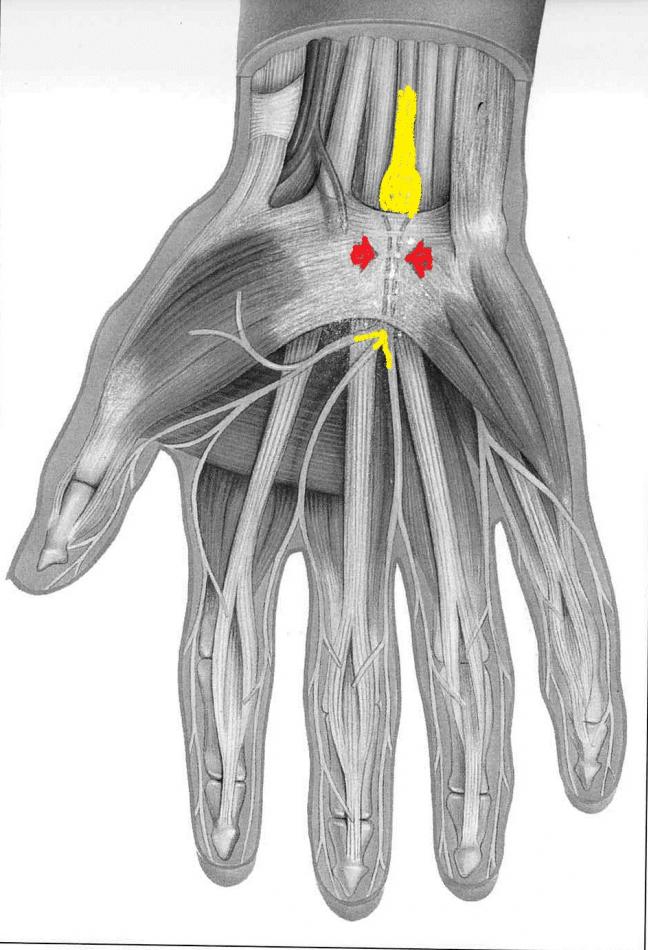 canal carpien, syndrome de compression du nerf median au canal carpien