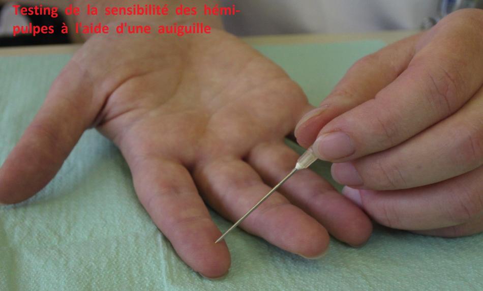 lesions ou sections nerveuses des doigts pathologies et operations ...