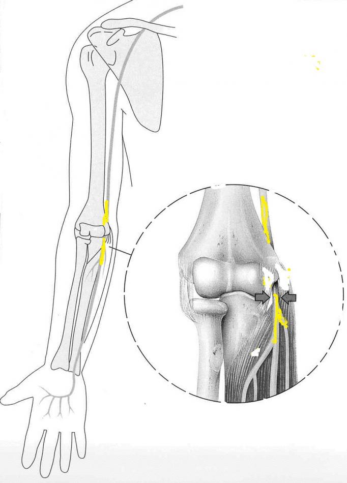 syndrome compression du nerf cubital ou ulnaire au pathologies