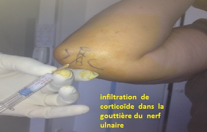 syndrome compression du nerf cubital ou ulnaire au pathologies