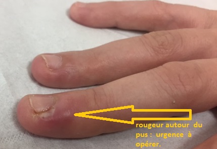panaris ou phlegmon dun doigt pathologies et operations doigts