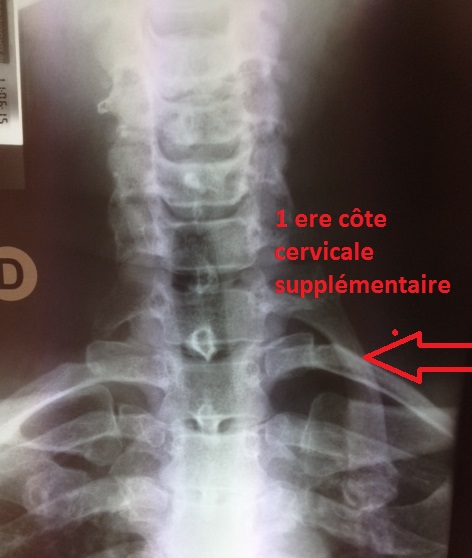 torticolis, douleur du cou, rachis cervical cervicalgies raideur ...