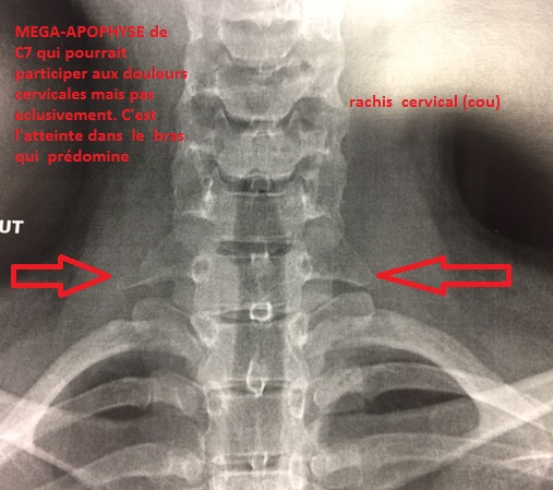 torticolis, douleur du cou, rachis cervical cervicalgies raideur ...
